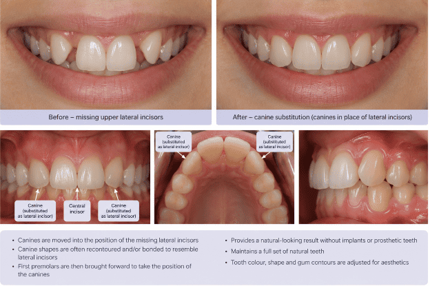 orthodontic space closure